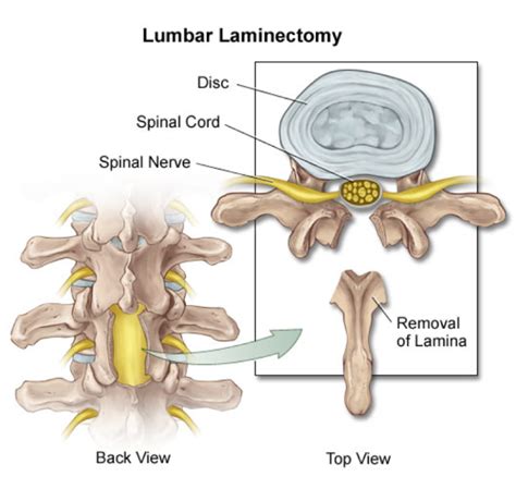 High-Quality Lumbar Laminectomy Surgery Cost In India-Medicare Spots