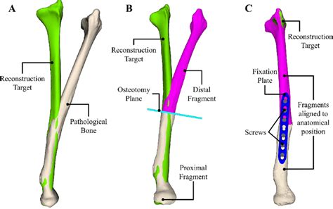 Overview of state-of-the-art preoperative planning of long-bone... | Download Scientific Diagram