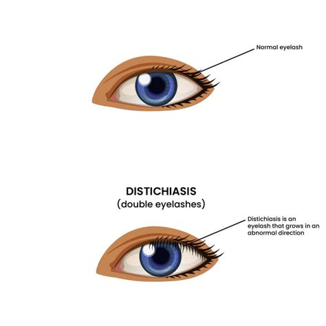 Double Eyelashes (Distichiasis) - Why Does It Happen?