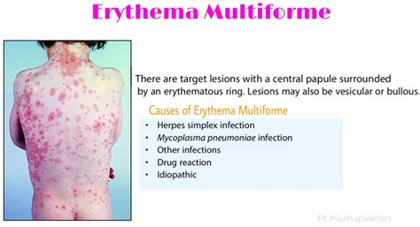 Erythema Multiforme | Dermatology, Skin assessment, Dermatology nurse