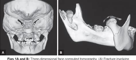 Figure 1 from Multiple Accessory Cusps in Maxillary Primary Second ...