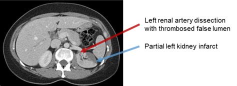 Cureus | A Rare Case of Isolated and Idiopathic Spontaneous Renal ...