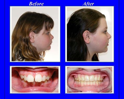 How Long To Correct Overbite With Braces / Carriere Motion 3d Appliance Garrick F Wong Dmd ...