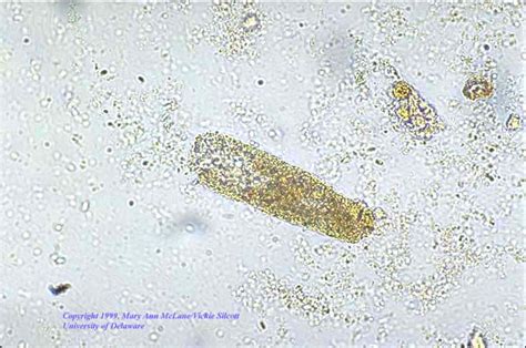 Granular Cast In Urine