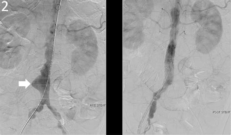 Angiography of aorta demonstrated an infrarenal AAA (white arrow in... | Download Scientific Diagram