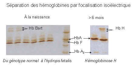 Hemoglobin Barts - Alchetron, The Free Social Encyclopedia