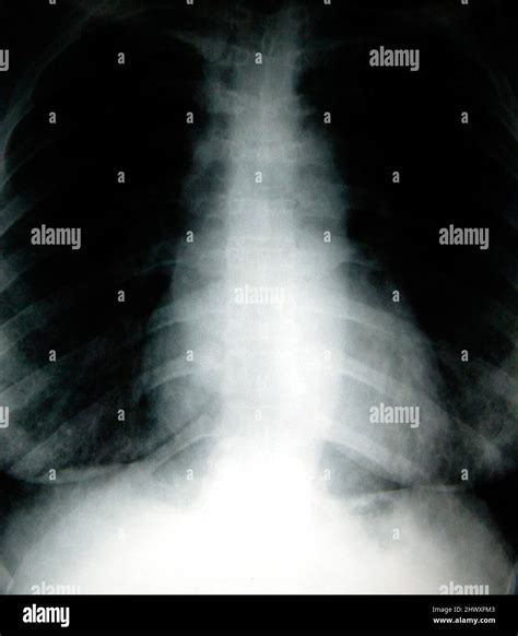 X-ray of a human rib cage Stock Photo - Alamy