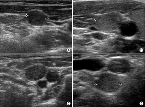 Ultrasound images of central lymph node metastasis. (A) LNM with a loss... | Download Scientific ...