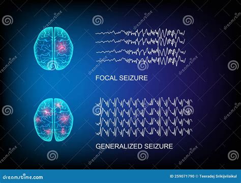 Illustration Of Seizure Types Demonstrating By Onset And Brain Waves Royalty-Free Stock Image ...