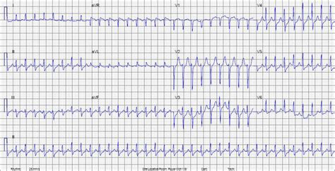 McGill EKG Learning Project