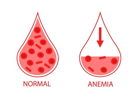 comparando dos gotas de sangre de células sanguíneas normales y ...