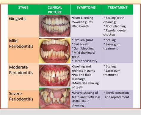 Laser Treatment For Gum Disease Cost - Pregnancy Informations