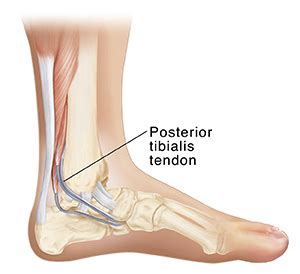 Understanding Posterior Tibialis Tenosynovitis | Saint Luke's Health System