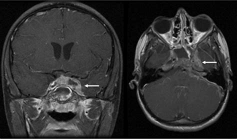 Cavernous Sinus Thrombosis - Diagnosis and Treatment - County EM