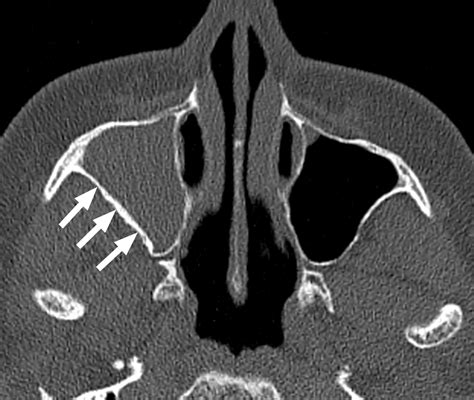 The Preoperative Sinus CT: Avoiding a “CLOSE” Call with Surgical Complications | Radiology