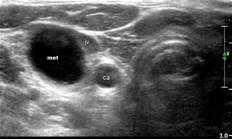 Ultrasound image of enlarged lymph node in level III of the right neck ...