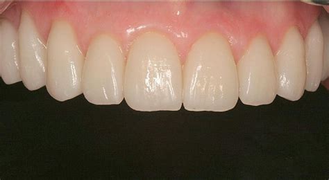 Dental Smile Esthetics: The Assessment and Creation of the Ideal Smile ...