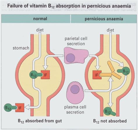 Intrinsic Factor Blocking Antibodies | Second Opinion Physician