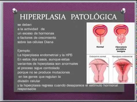 Hipertrofia - Hiperplasia - YouTube