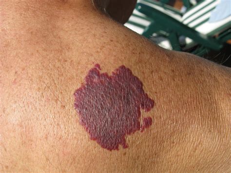 When to Consider Birthmark Removal | Premier Dermatology