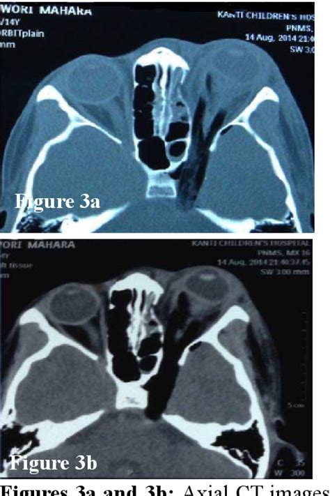 Structure of inferior conjunctival fornix | Semantic Scholar