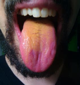 What Causes Orange Tongue, How is This Coating or Film Cured ...