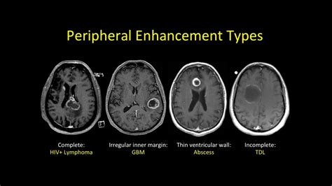 Ms Mri Brain Scan Results