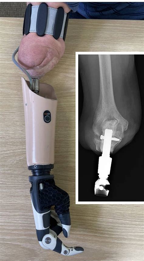 Benefits of osseointegration over socket implants for amputees