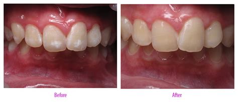 Fluorosis Treatment | Enhance Dental