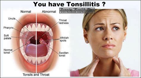 4 Benefical Ways To Remove Tonsil Stones