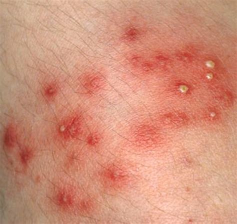 Staph Infection - Pictures, Contagious, Symptoms, Treatment, Causes ...