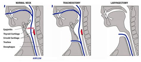 What is a Laryngectomy | Larykins Laryngectomy Support