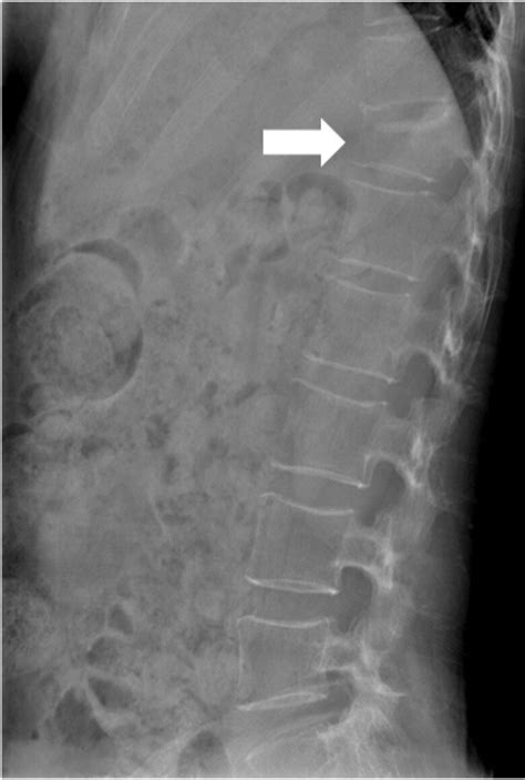 Thoraco-lumbar spine series showed compression fracture on 12th ...