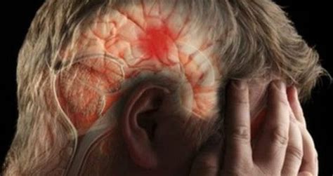 Infarto cerebral: síntomas para detectarlo a tiempo. - Ate Anuncios