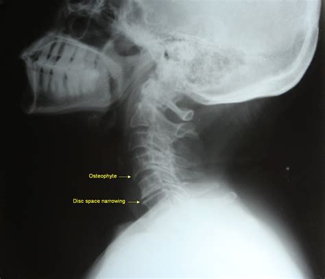 Cervical Uncinate Hypertrophy