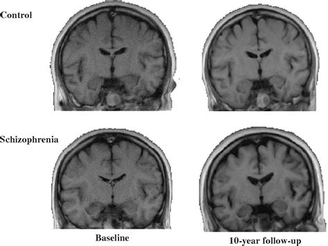 Figure 1 from A review of MRI studies of progressive brain changes in ...