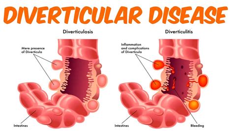 Diverticulosis And Diverticulitis! - YouTube