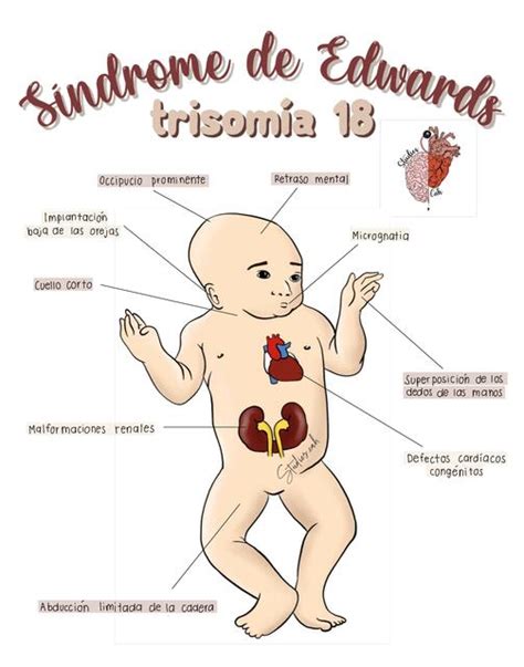 Síndrome de Edwards (trisomía 18) | Studiescah | uDocz