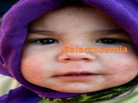 Galactosemia