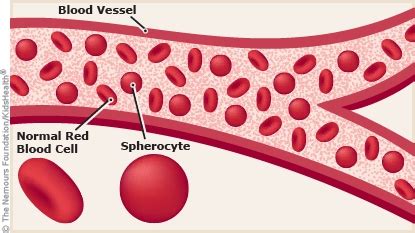 Hereditary Spherocytosis (for Parents) - Rady Children's Hospital (XML)