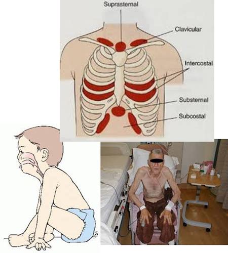 PE - Advanced Pulmonary Exam - Lec. 14 - Farrish - Cura Personalis Flashcards | Quizlet