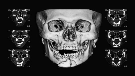 How Long Does A Fractured Jaw Take To Heal - SilverLake ER