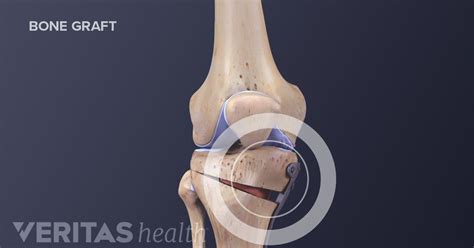 Knee Osteotomy Surgery Procedure