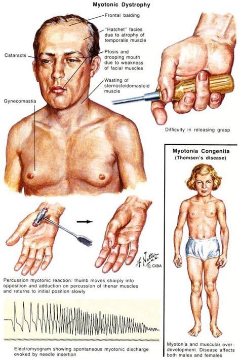 Myotonic dystrophy - learn all about it in 5 minutes - Costamedic