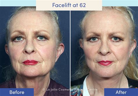 Facelift Before & After Photos: What a Facelift Looks Like at 40, 50 ...