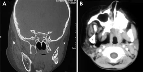 Coronal (A) and axial (B) CT images (bone window and so | Open-i