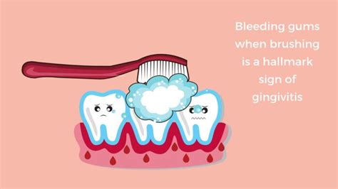 Bleeding gums, gingivitis and how to fix it - Method Dental