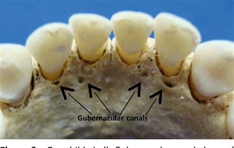 [PDF] Gubernacular cord and canal: does these anatomical structures play a role in dental ...