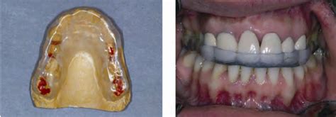 Michigan splint on a model (left) and the inserted splint in the ...