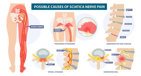 Sciatic Pain Chiropractic Care - Johnstown, CO Chiropractic Care